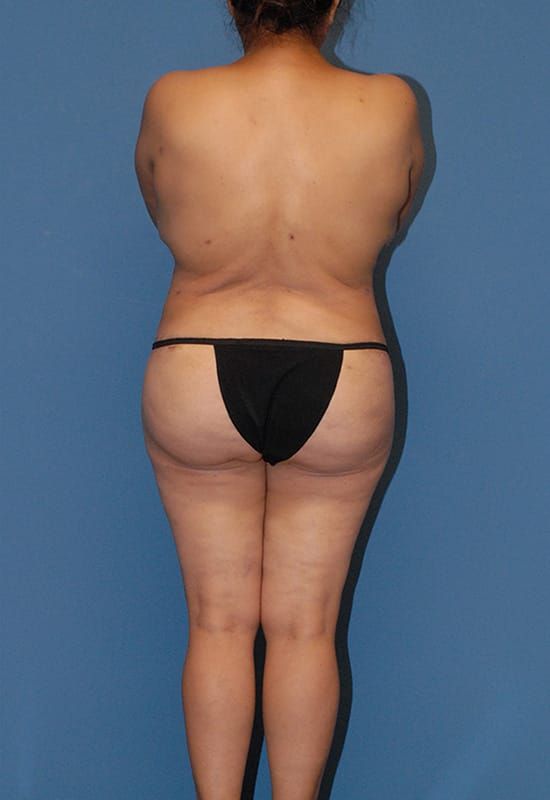 Liposuction Before & After