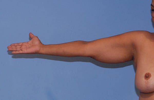 Liposuction Before & After