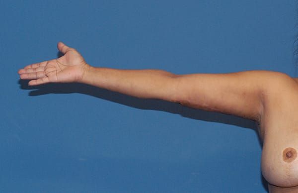 Liposuction Before & After