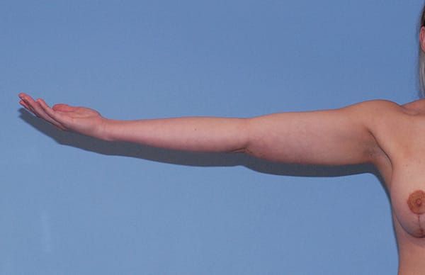 Liposuction Before & After