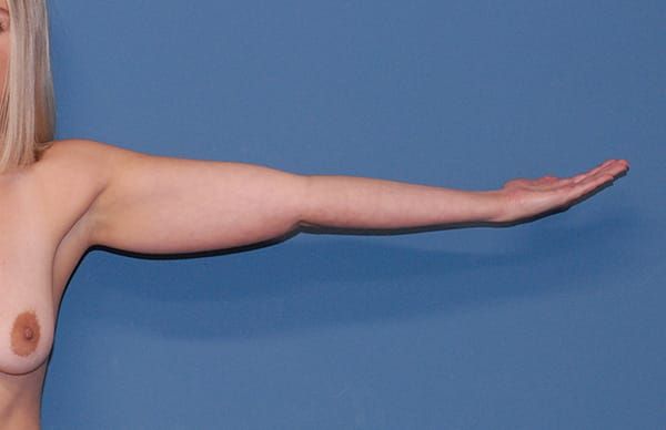 Liposuction Before & After