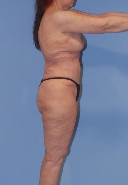 Liposuction Before & After