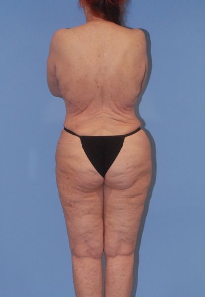 Liposuction Before & After