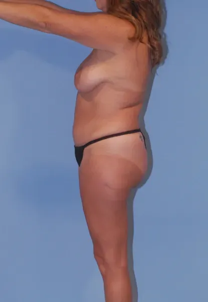 Liposuction Before & After