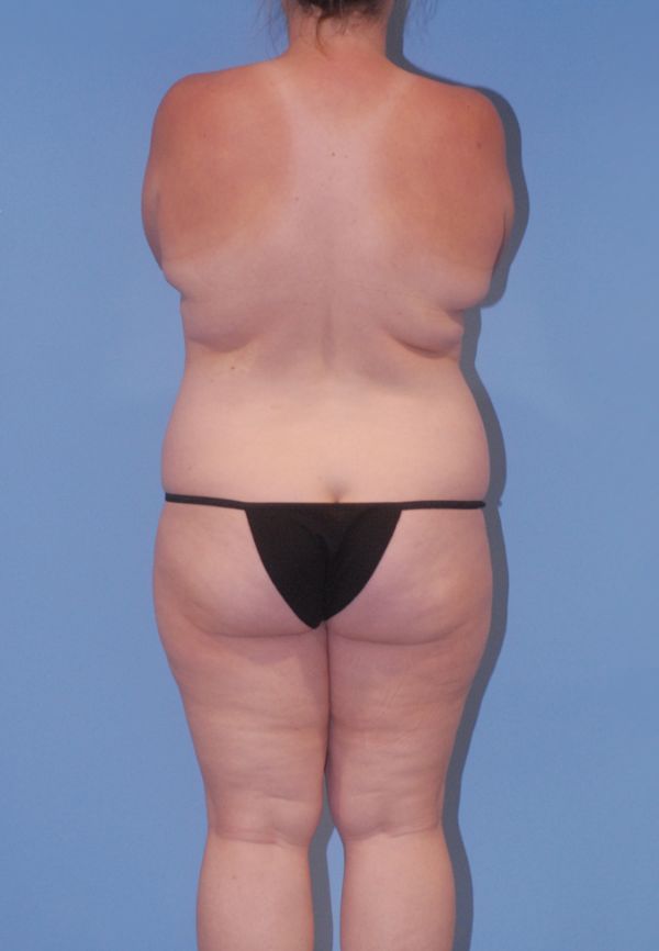 Liposuction Before & After