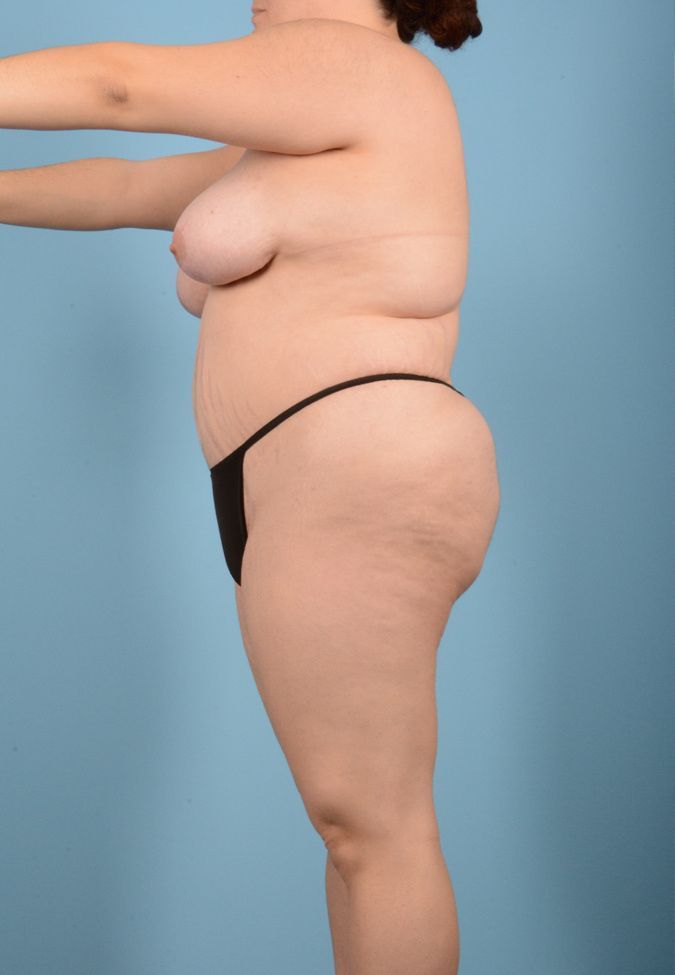 Liposuction Before & After