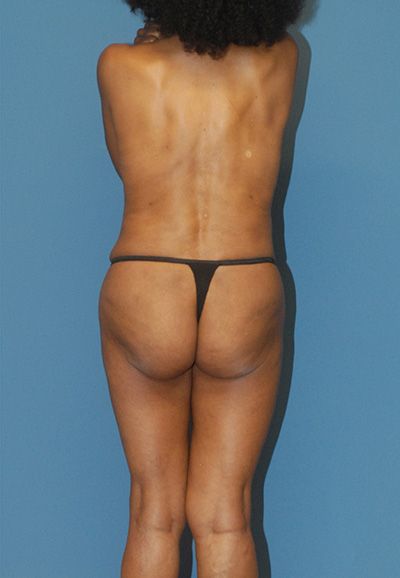 Liposuction Before & After