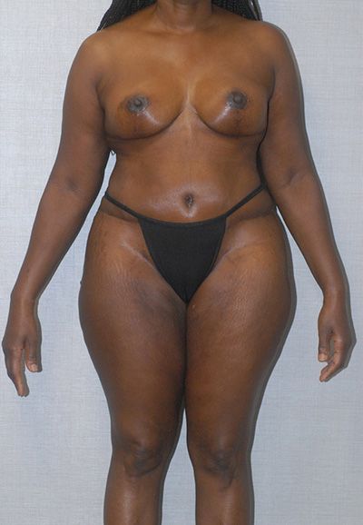 Liposuction Before & After