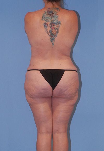 Liposuction Before & After