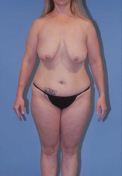 Liposuction Before & After
