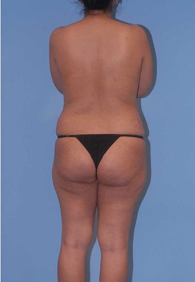 Liposuction Before & After