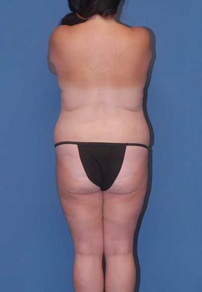 Liposuction Before & After