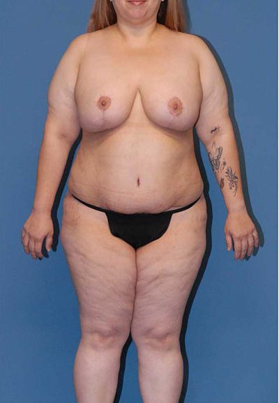 Liposuction Before & After