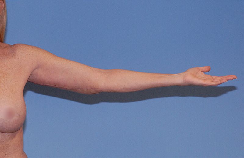 Liposuction Before & After