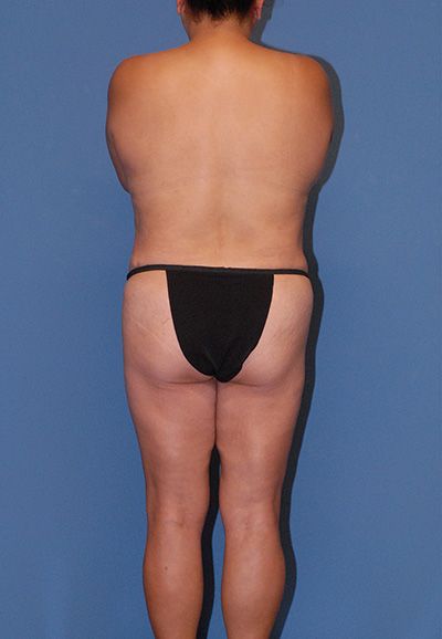 Liposuction Before & After