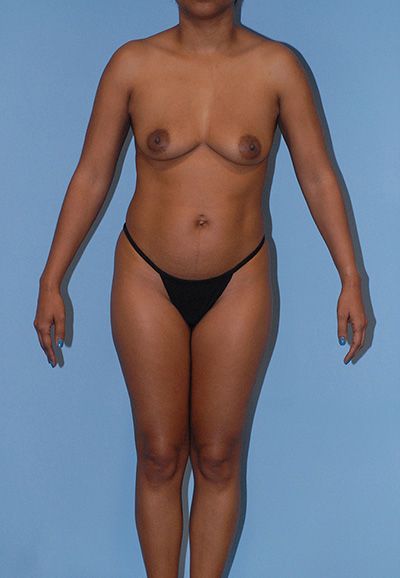 Liposuction Before & After