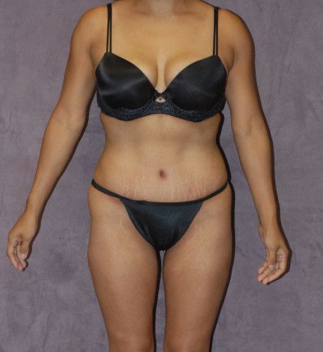 Liposuction Before & After