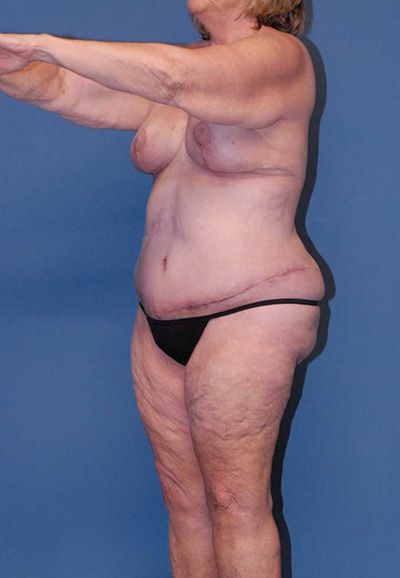 Liposuction Before & After