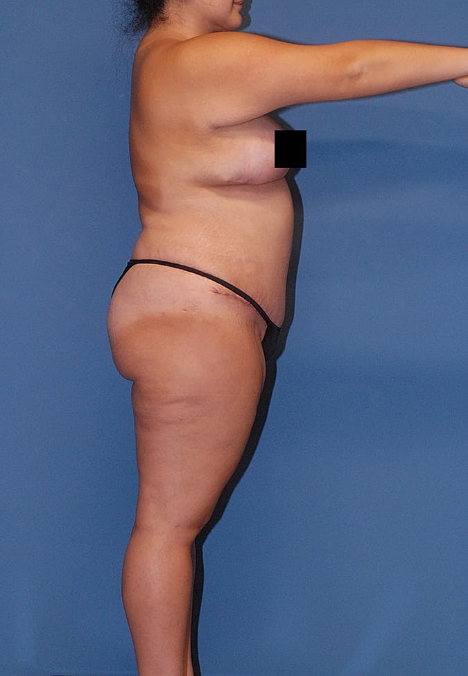 Liposuction Before & After