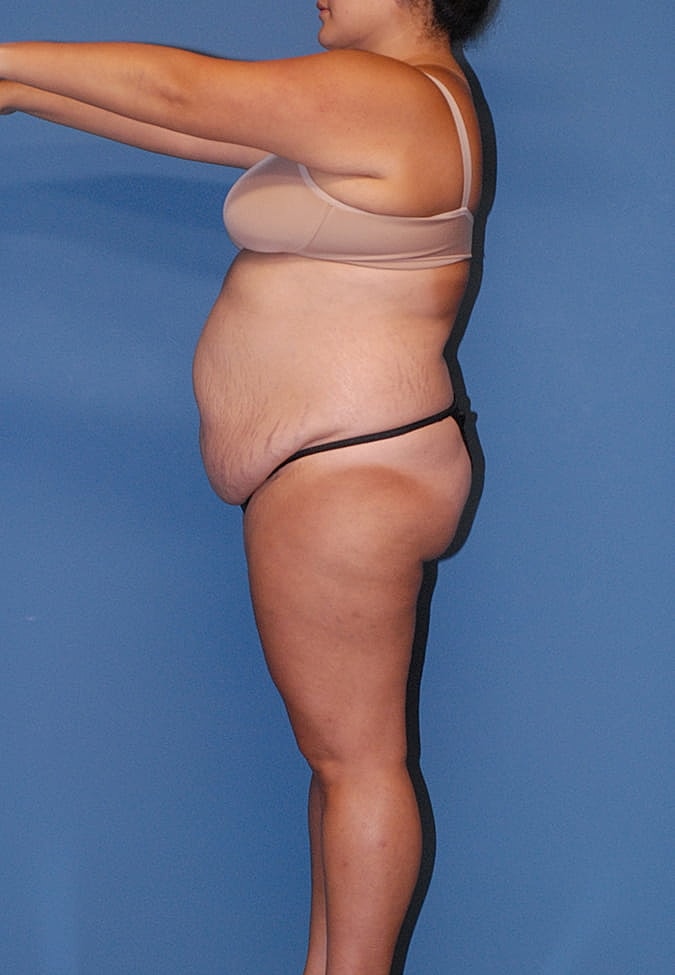 Liposuction Before & After