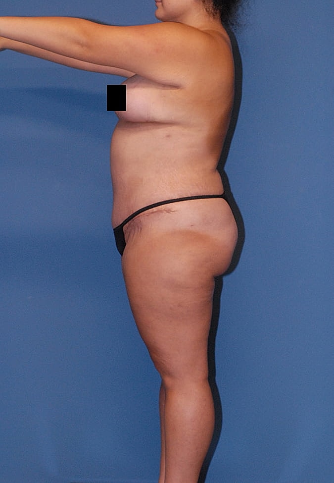 Liposuction Before & After
