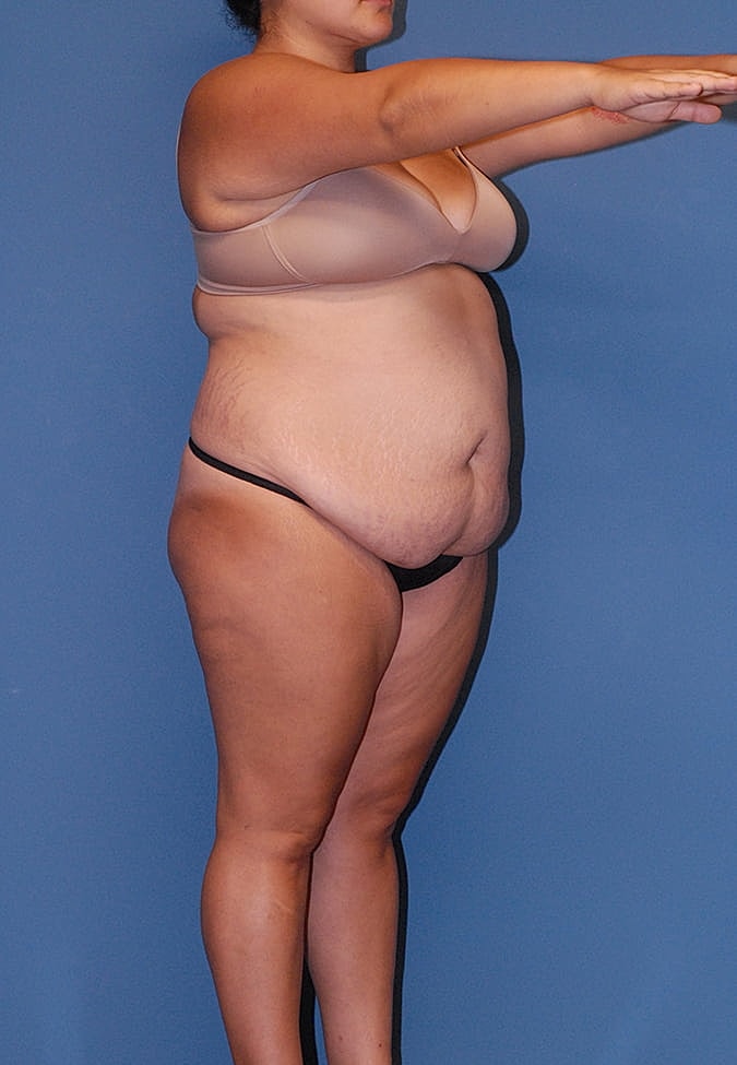 Liposuction Before & After