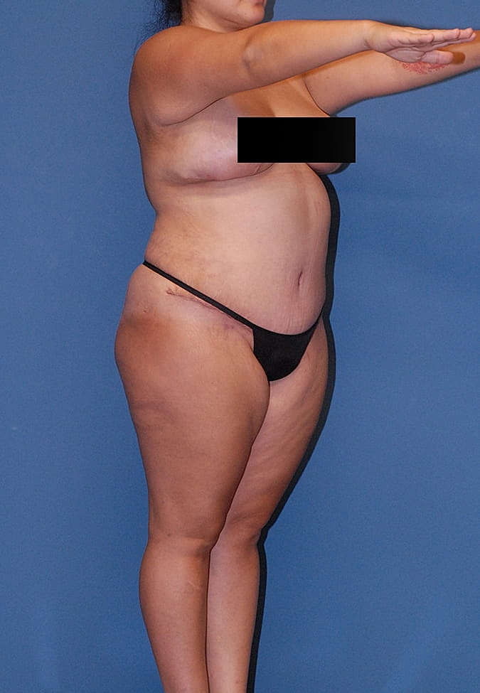 Liposuction Before & After