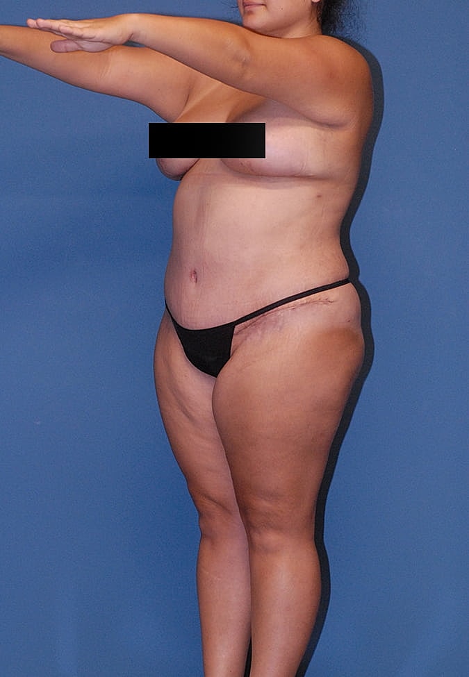 Liposuction Before & After