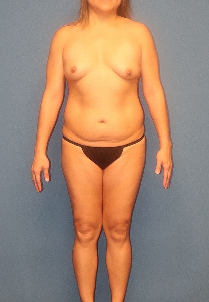 Liposuction Before & After