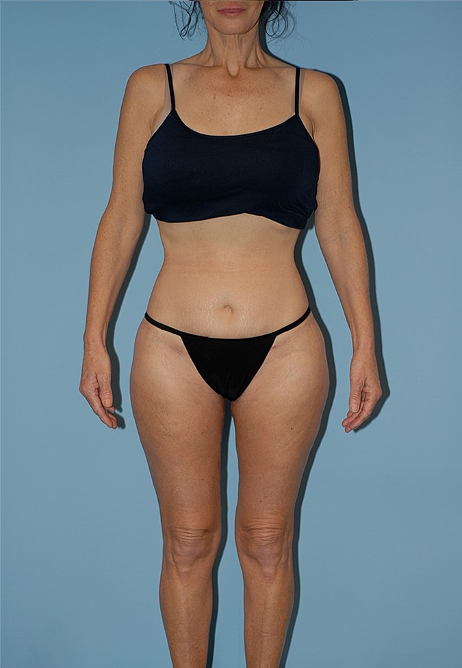 Liposuction Before & After
