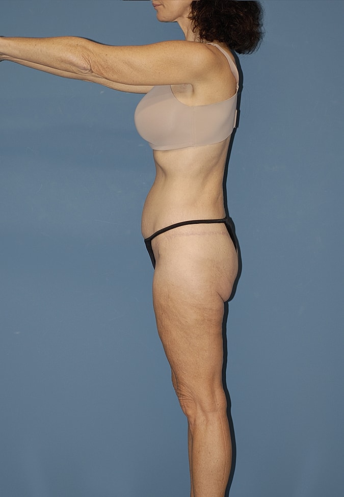 Liposuction Before & After