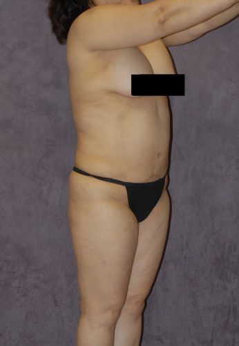 Liposuction Before & After