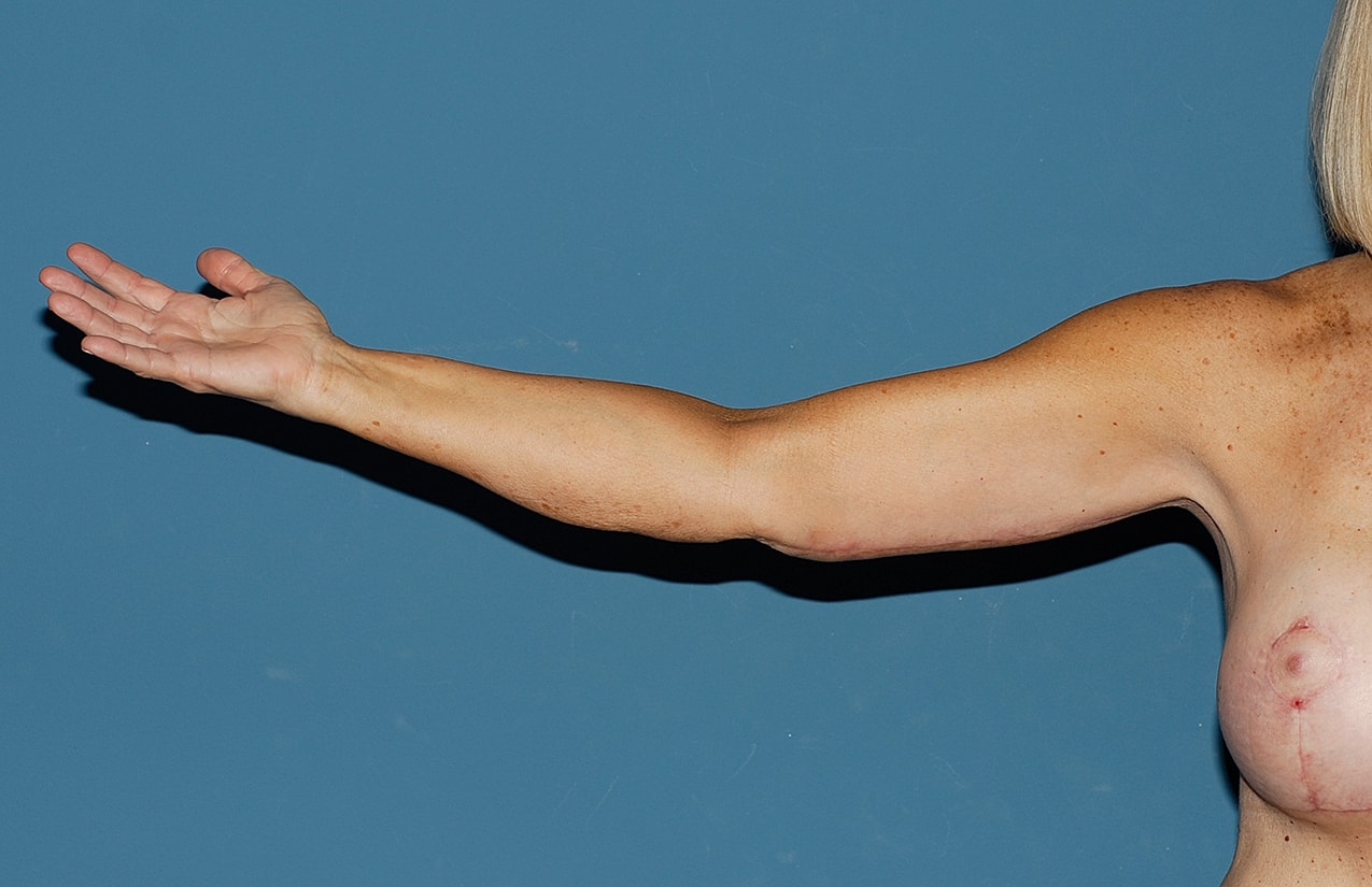 Liposuction Before & After
