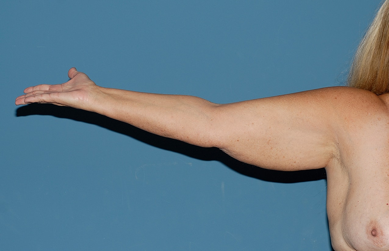 Liposuction Before & After