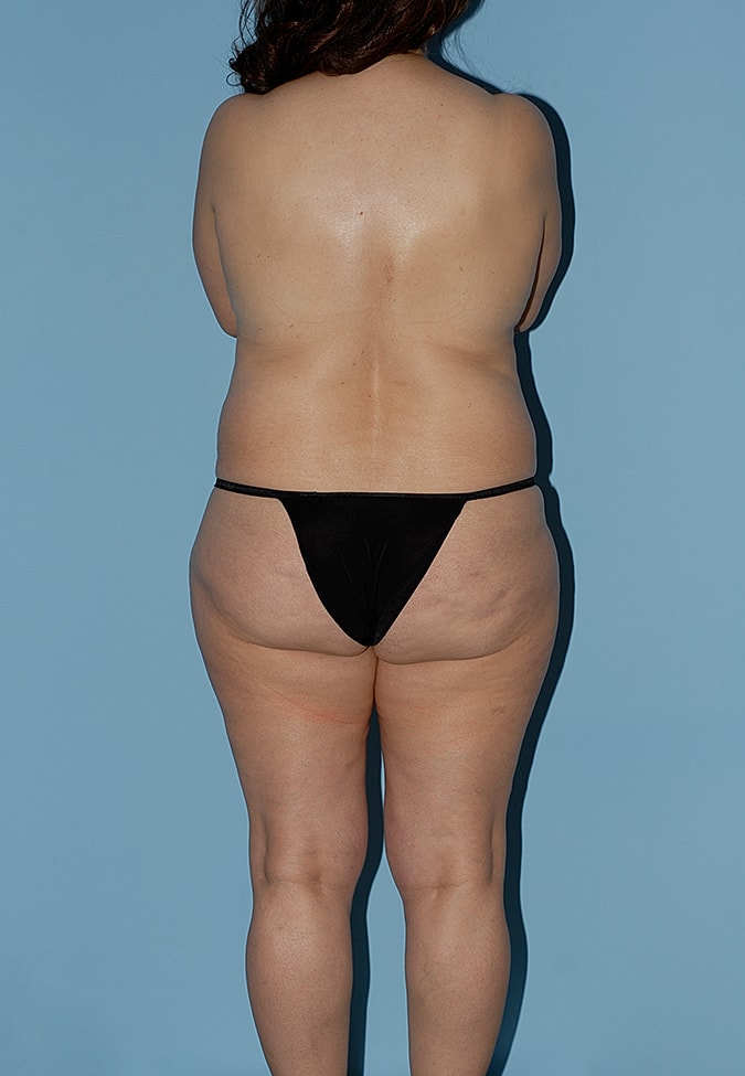 Liposuction Before & After