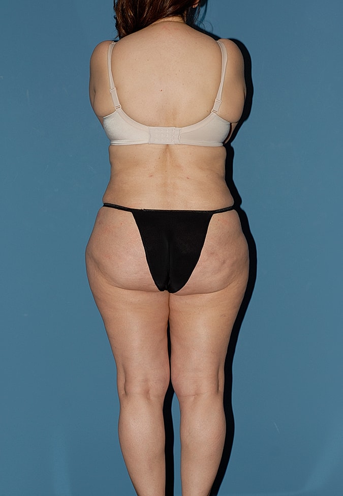 Liposuction Before & After