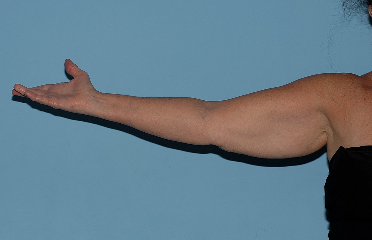 Liposuction Before & After