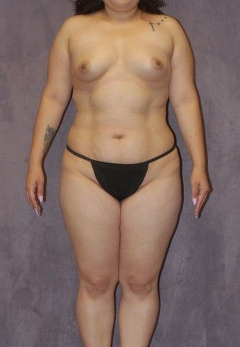 Liposuction Before & After