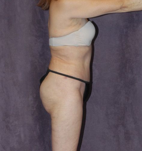 Liposuction Before & After