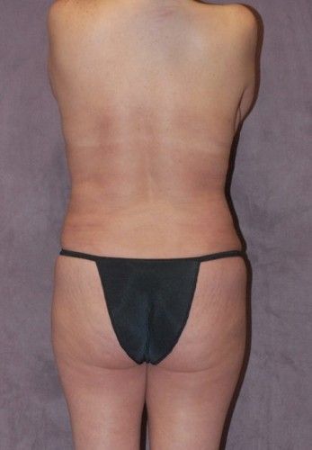 Liposuction Before & After