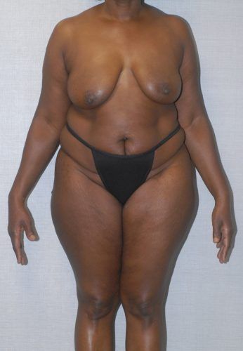 Liposuction Before & After