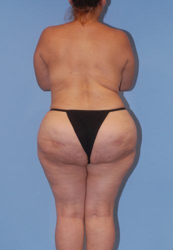 Liposuction Before & After