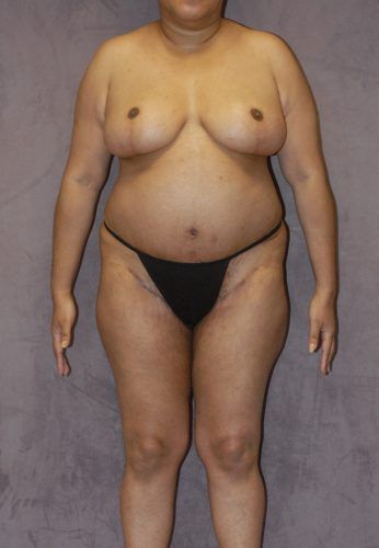 Liposuction Before & After