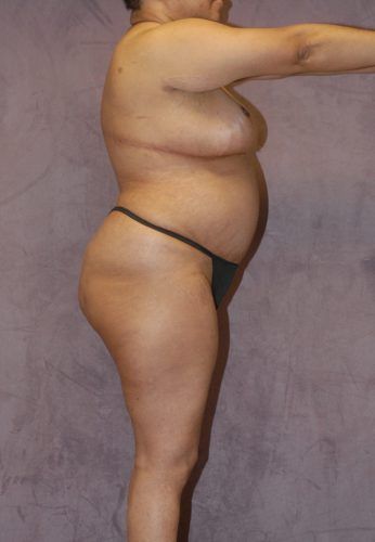 Liposuction Before & After