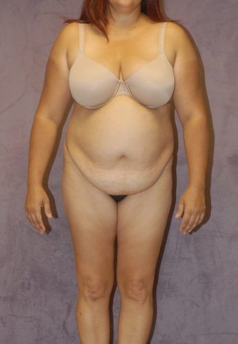 Liposuction Before & After