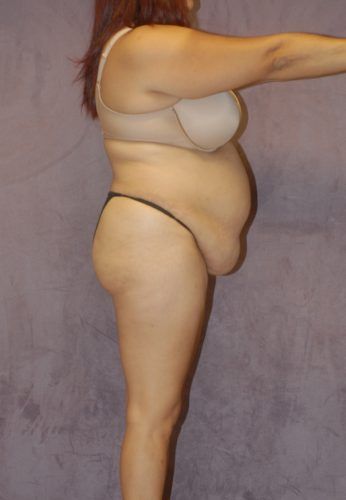 Liposuction Before & After