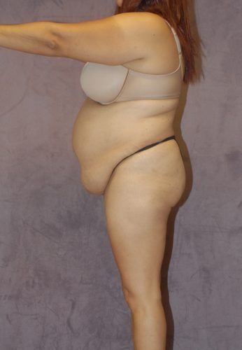 Liposuction Before & After