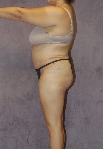 Liposuction Before & After