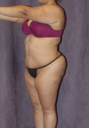 Liposuction Before & After