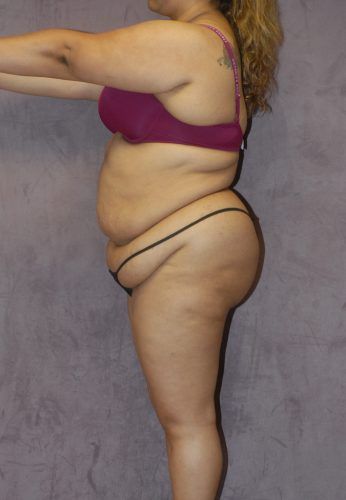 Liposuction Before & After